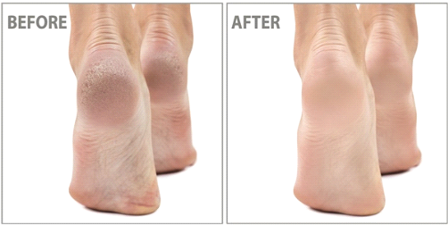 Pediluxe..a facial for your feet!